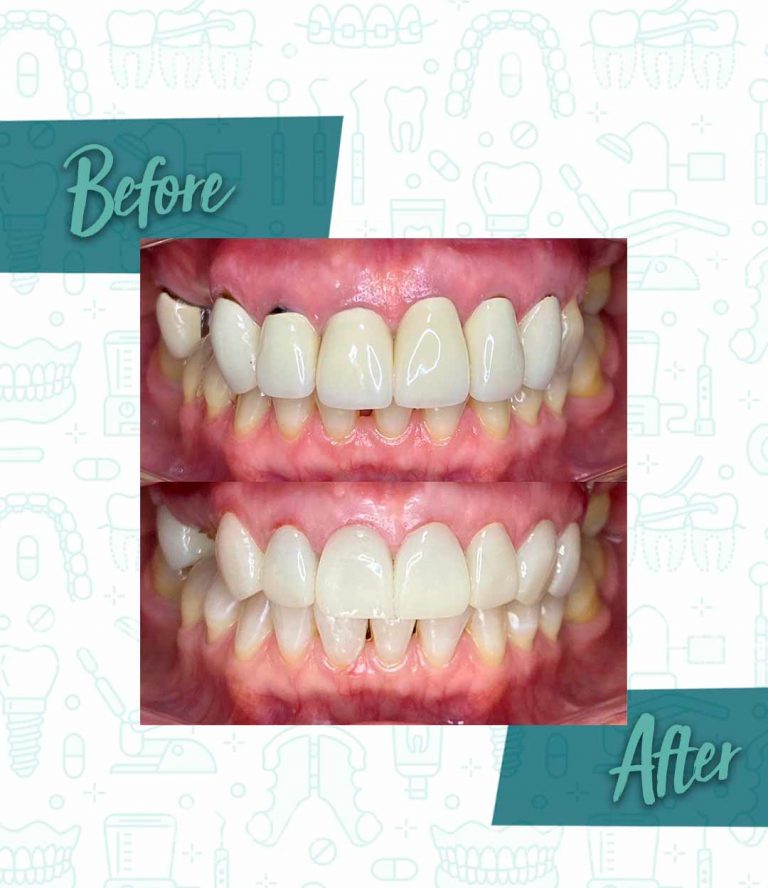 Benefits of maintaining good oral hygiene